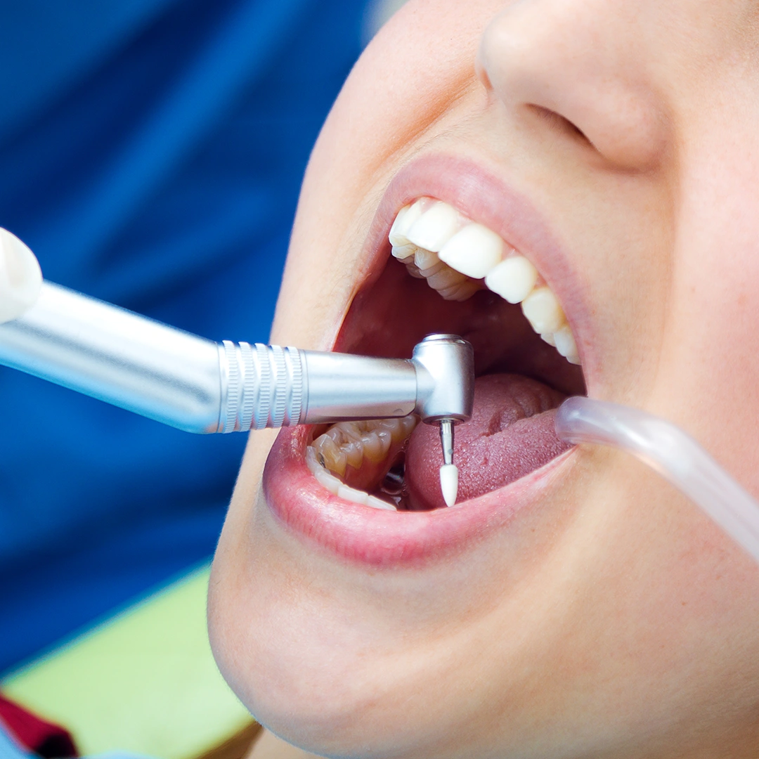 Root Canal Treatment