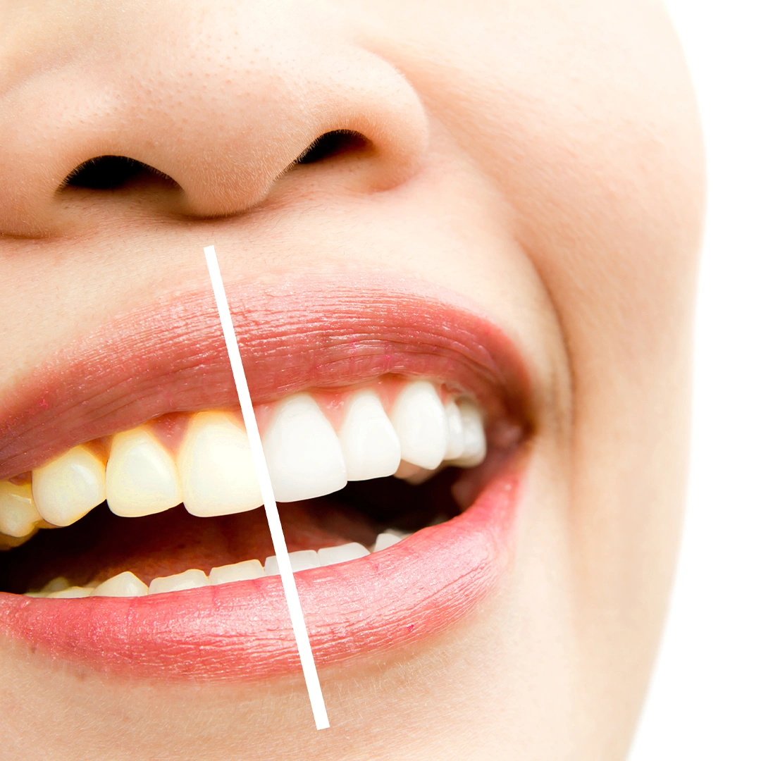 Veneers